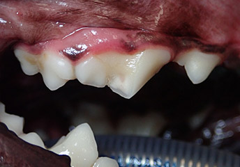 破折の歯冠修復